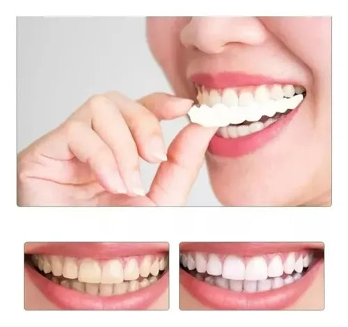 Carillas Dentales Completas - Superior e Inferior