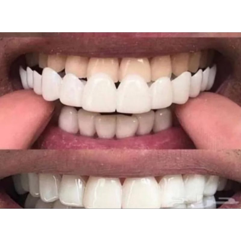 Carillas Dentales Completas - Superior e Inferior